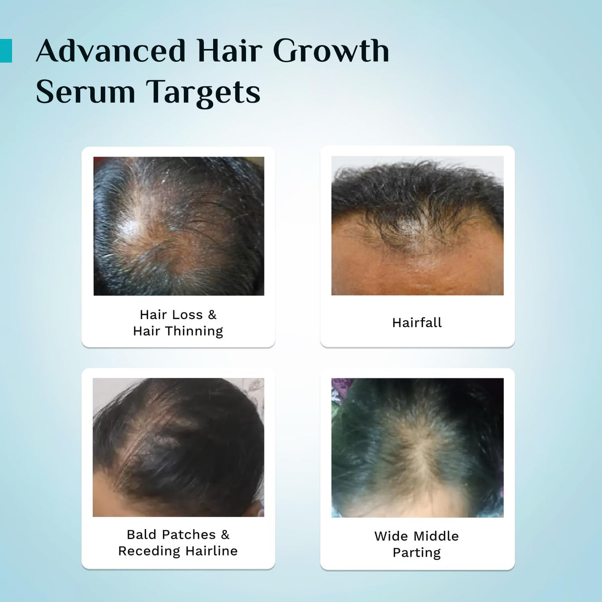 Pilgrim Redensyl 3% + Anagain 4% + Baicapil Advanced Hair Growth Serum (30ml) for Scalp with Korean Black Rice, Saw Palmetto | Control Fall, Stimulate Regrowth, Increase Density | For Women & Men