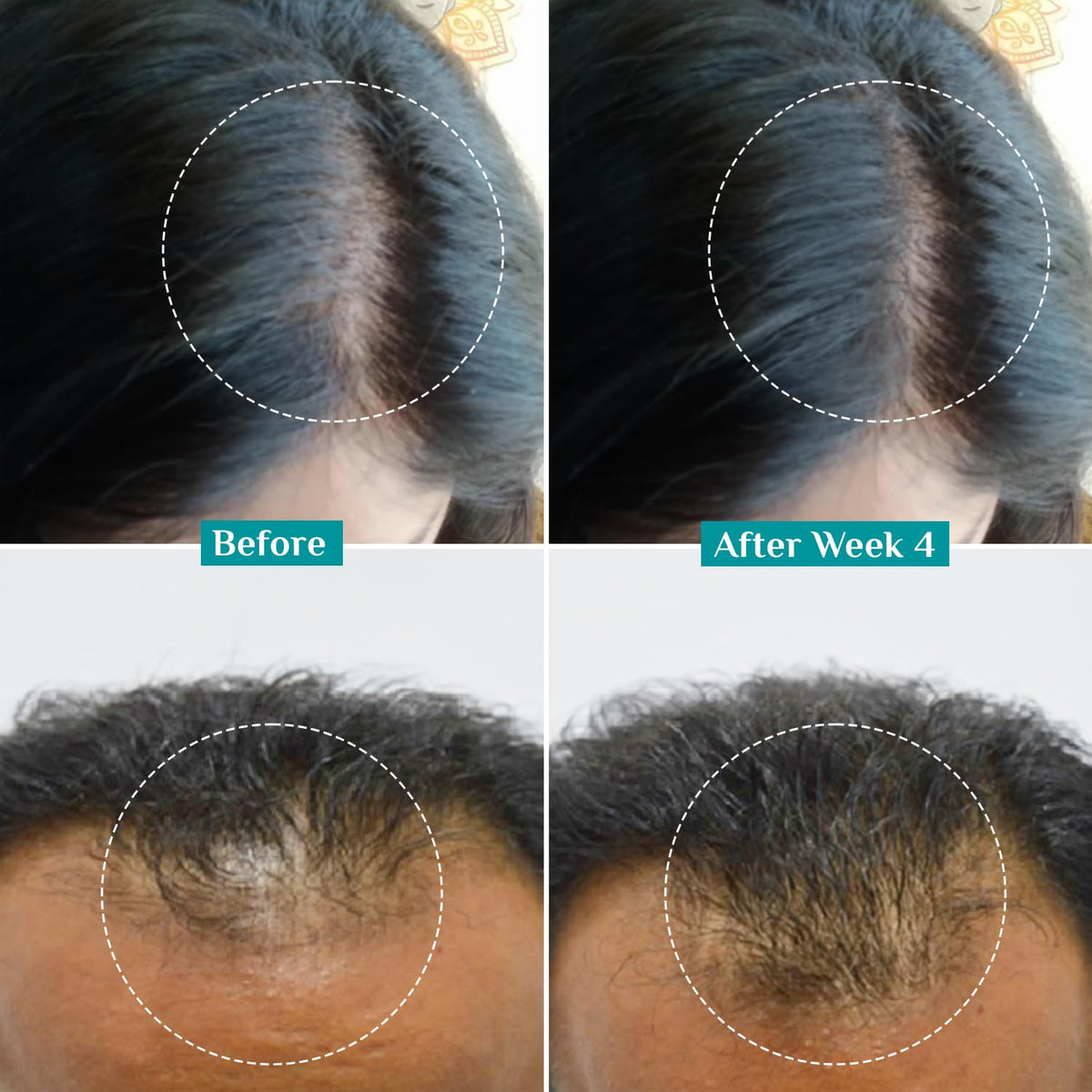 Pilgrim Redensyl 3% + Anagain 4% + Baicapil Advanced Hair Growth Serum (30ml) for Scalp with Korean Black Rice, Saw Palmetto | Control Fall, Stimulate Regrowth, Increase Density | For Women & Men