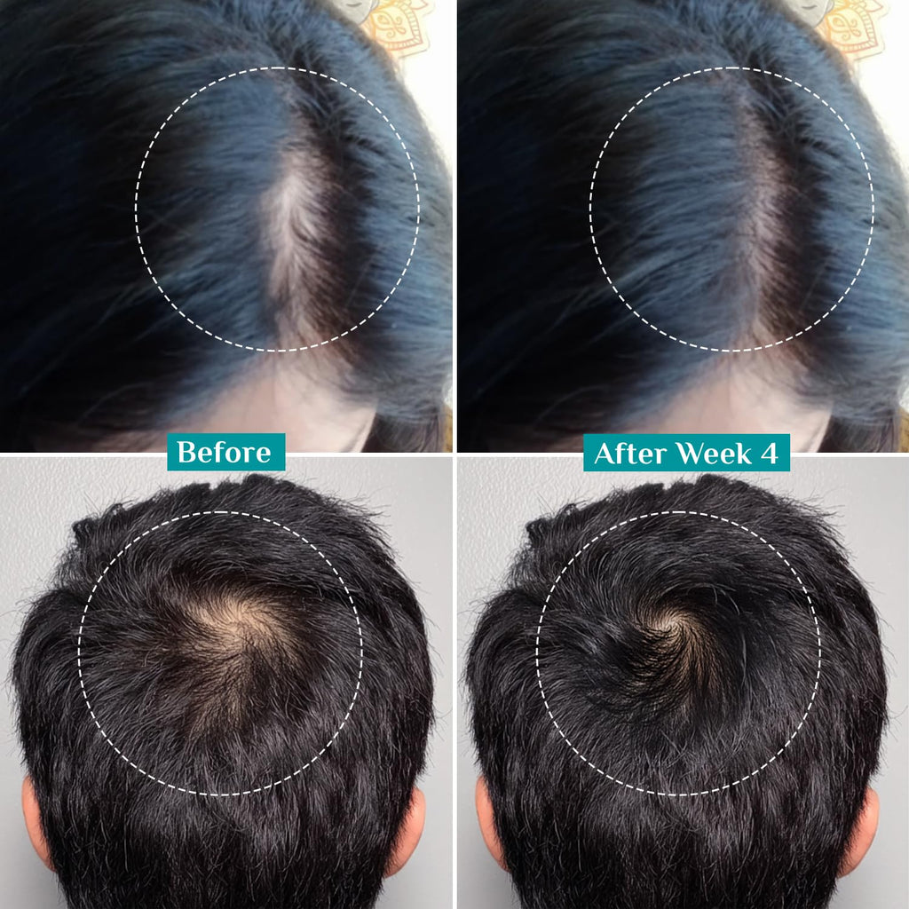 Pilgrim Redensyl 3% + Anagain 4% + Baicapil Advanced Hair Growth Serum (30ml) for Scalp with Korean Black Rice, Saw Palmetto | Control Fall, Stimulate Regrowth, Increase Density | For Women & Men