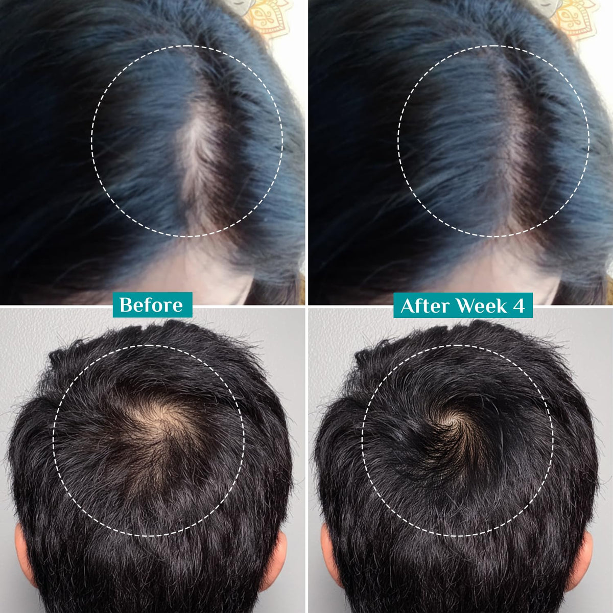 Pilgrim Redensyl 3% + Anagain 4% + Baicapil Advanced Hair Growth Serum (30ml) for Scalp with Korean Black Rice, Saw Palmetto | Control Fall, Stimulate Regrowth, Increase Density | For Women & Men